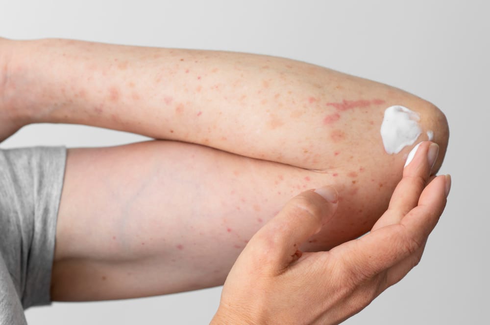 Грибковые заболевания кожи: диагностика и лечение