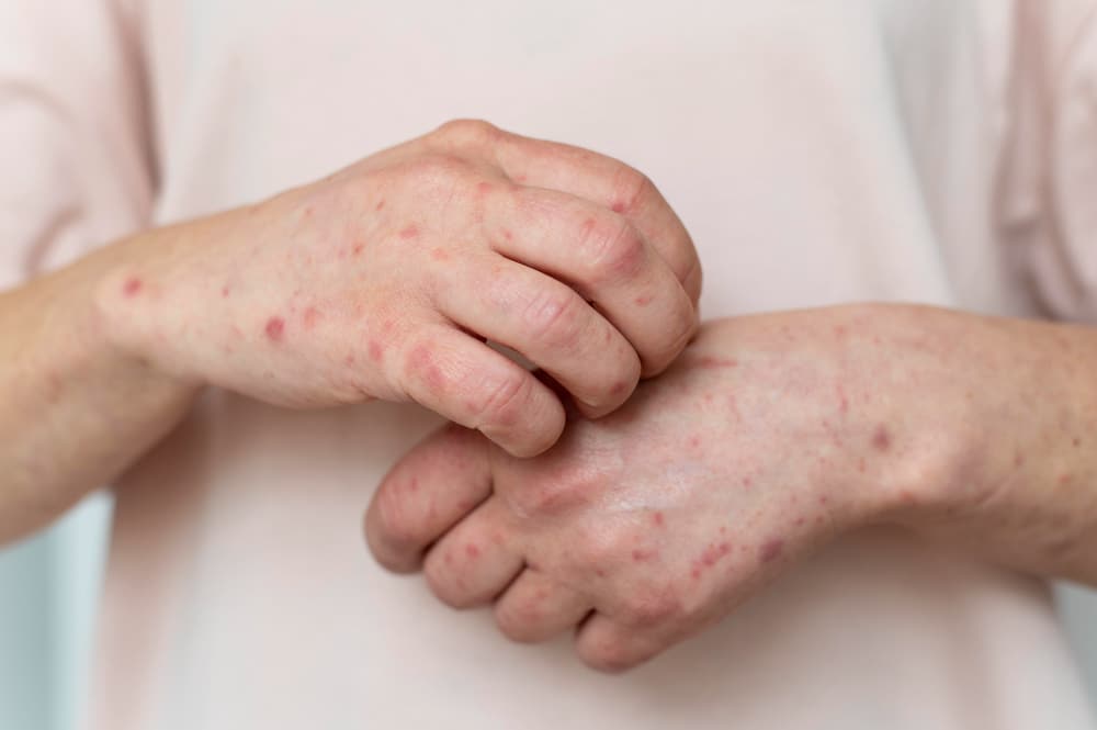 Кожные проявления аллергии: диагностика и лечение